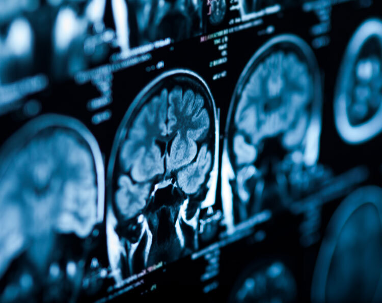 MRI Images